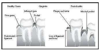 Oral diseases like gingivitis (left) and periodontitis (right) may result from overnutrition. When food consumption is excessive, or when the foods consumed are frequently sugary or acidic, the enamel on teeth can dissolve and gums can be infected. [The Gale Group.]