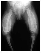 This X-ray of an infant afflicted by scurvy shows some of the skeletal effects of the disease, including bowed legs, stunted bone growth, and swollen joints. Infants who are fed only cow's milk are at risk of developing scurvy, since cow's milk is not an adequate source of vitamin C. [Photograph by Lester V. Bergman. Corbis Images. Reproduced by permission.]